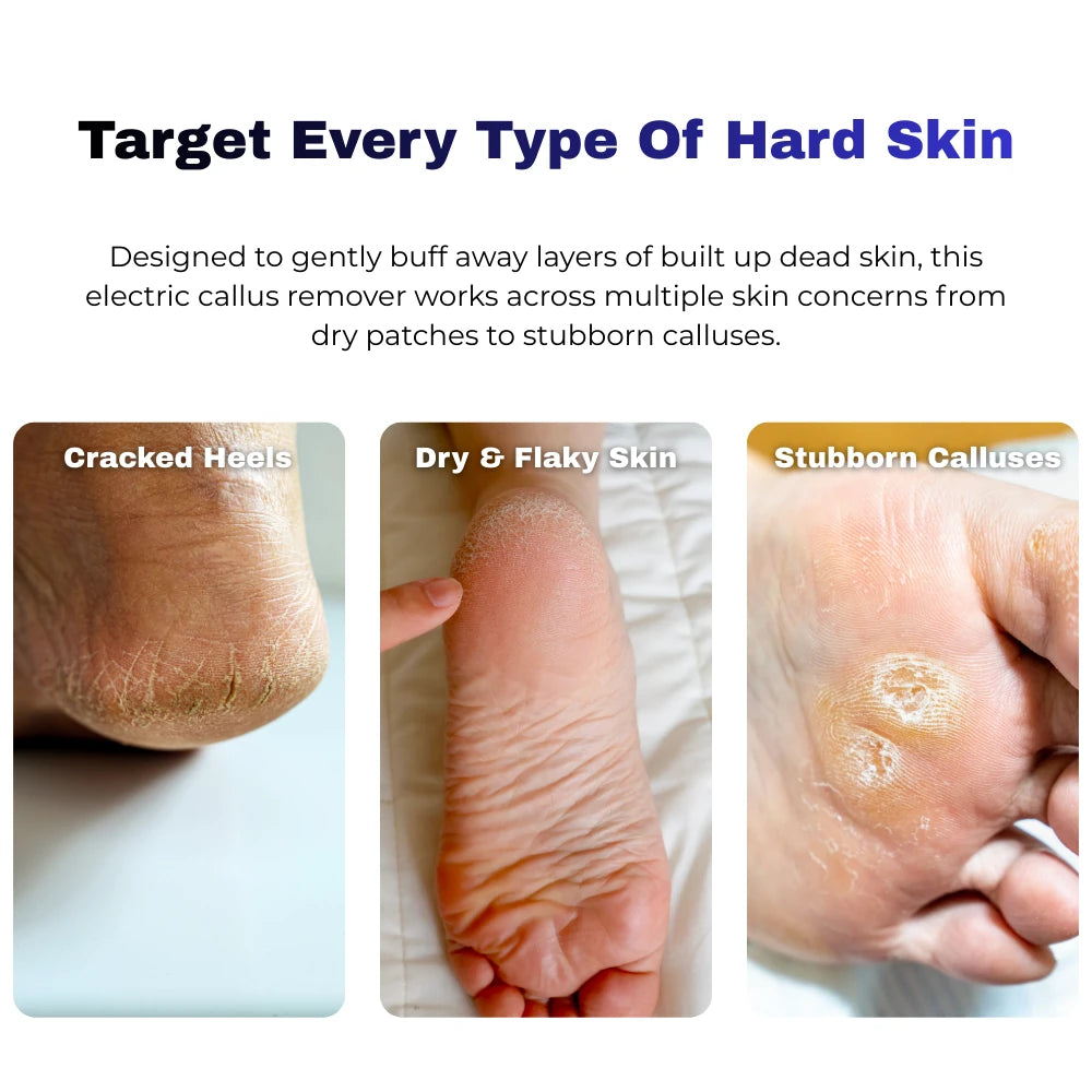 electric callus remover targeting cracked heels dry skin and stubborn calluses