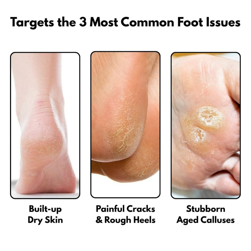Common foot issues like dry skin, cracked heels, and calluses treated by SilkySole Electric Callus Remover